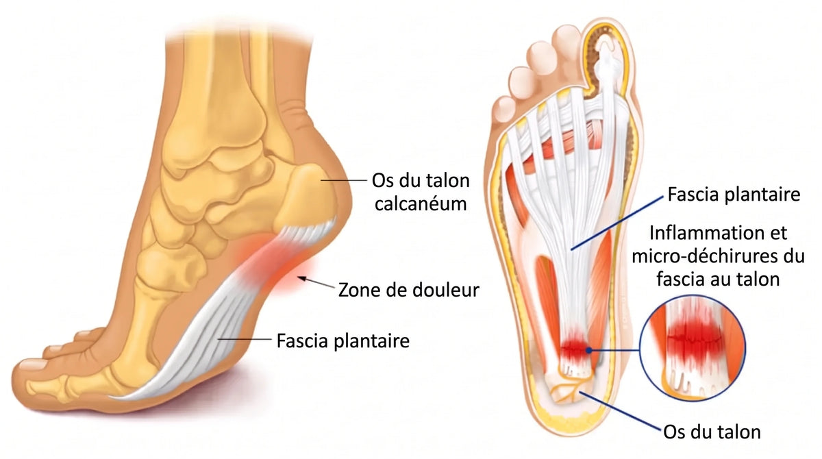 Le fascia plantaire, l'os du talon et la zone d'inflammation sous le pied